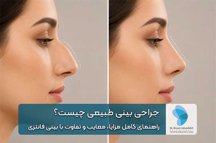 جراحی بینی طبیعی چیست؟ راهنمای کامل مزایا، معایب و تفاوت با بینی فانتزی