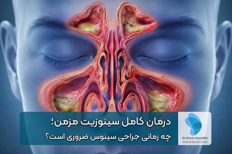 درمان سینوزیت مزمن