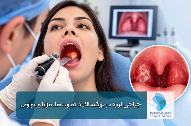 جراحی لوزه در بزرگسالان